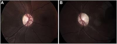 Use of Optical Coherence Tomography to Detect Retinal Nerve Fiber Loss in Children With Optic Pathway Glioma